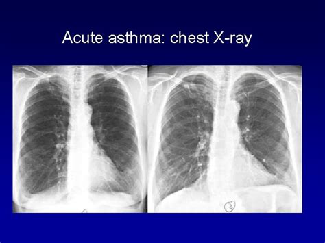 x ray for asthma|Asthma .